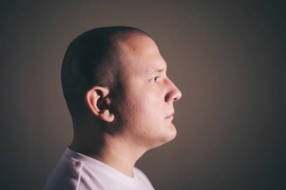 Haartransplantatie